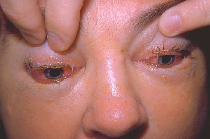 Zwelling rond de ogen: een van de eerste symptomen van trichinose
