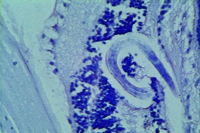In deze weefselcoupe van het verwijderd oog van een negenjarig meisje is de Toxocara-larve goed zichtbaar . © Prof Lamina.